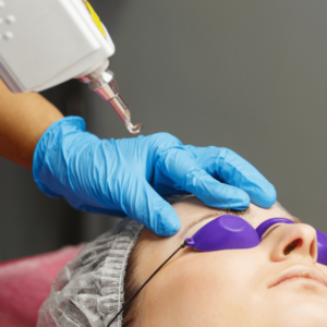 Procedimiento remocion con laser